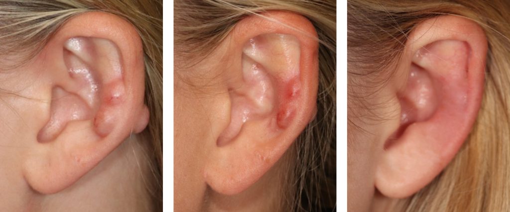 Ear Keloids