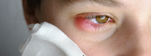 Chalazion Treatment