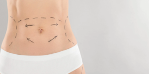 Mini Tummy Tuck 